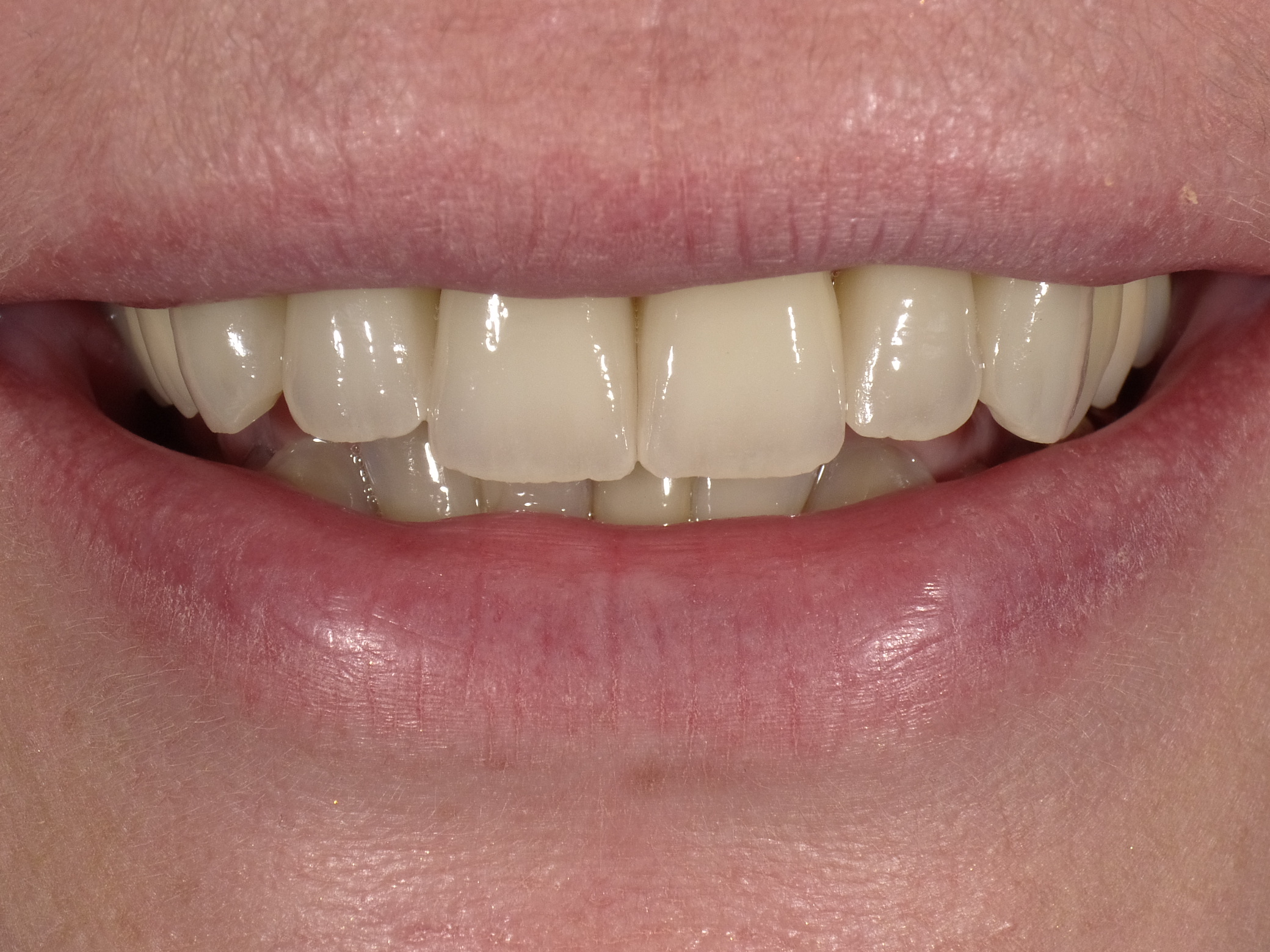 Entfernung des wurzelbehandelten Zahnes; Sofort-Implantat und leuchtende Vollkeramik-Kronen